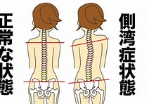 当院の側弯症改善法